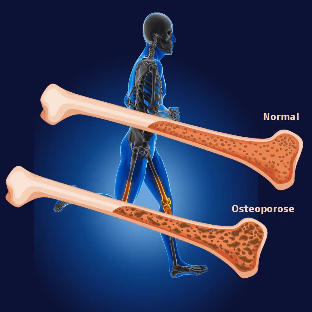 osteoporose massage